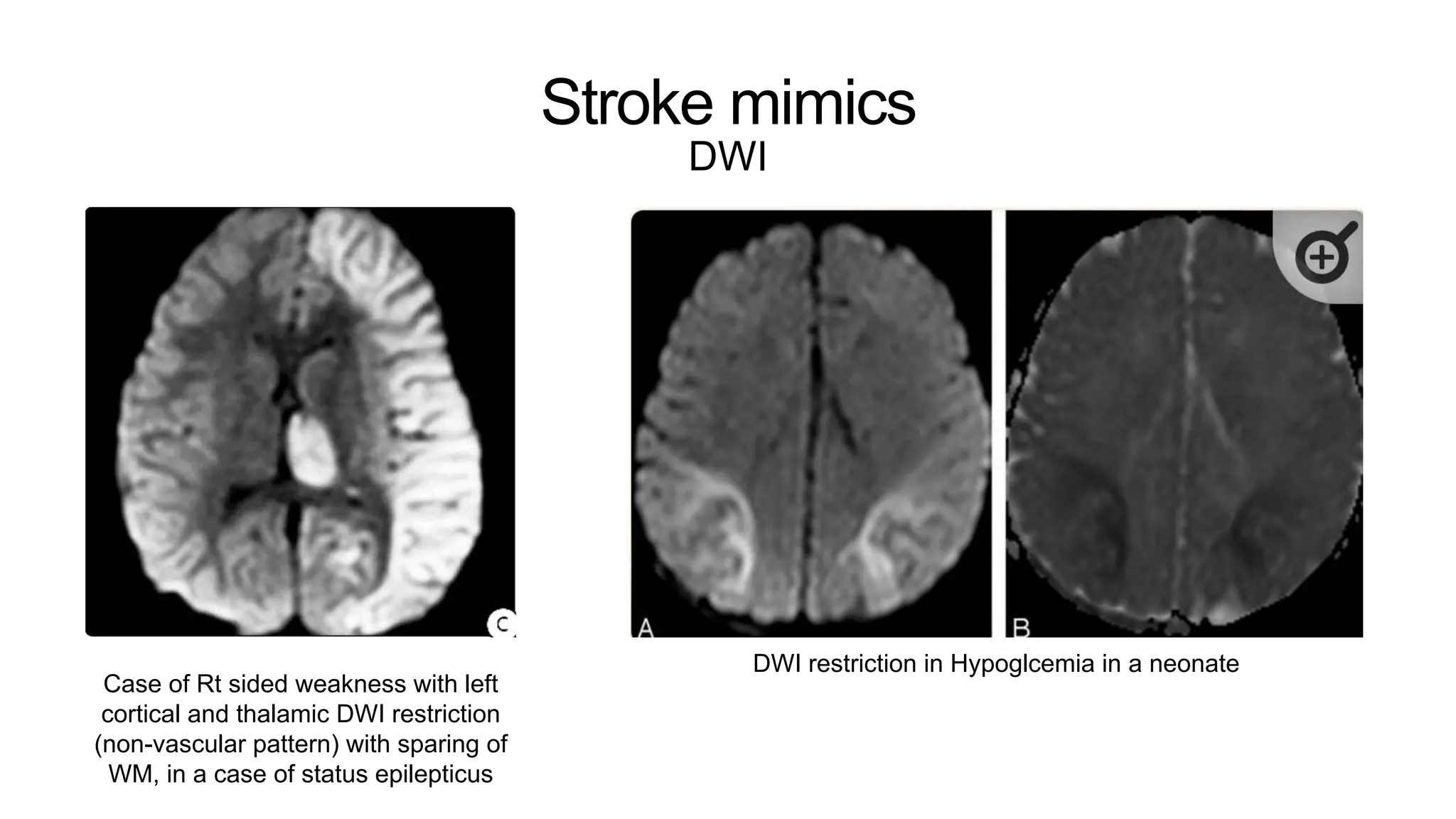 Stroke mimics
DWI
Case of Rt sided weakness with left
cortical and thalamic DWI restriction
(non-vascular pattern) with sparing of
WM, in a case of status epilepticus
DWI restriction in Hypoglcemia in a neonate
 