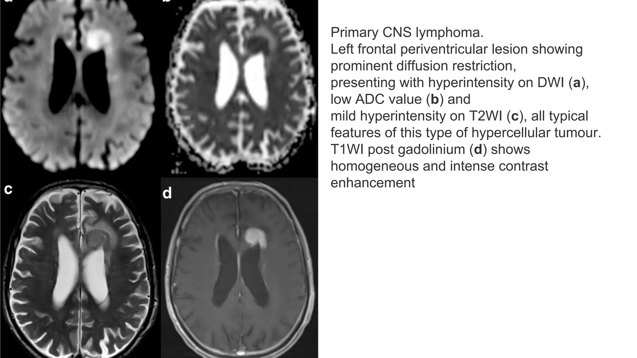 Primary CNS lymphoma.
Left frontal periventricular lesion showing
prominent diffusion restriction,
presenting with hyperintensity on DWI (a),
low ADC value (b) and
mild hyperintensity on T2WI (c), all typical
features of this type of hypercellular tumour.
T1WI post gadolinium (d) shows
homogeneous and intense contrast
enhancement
 