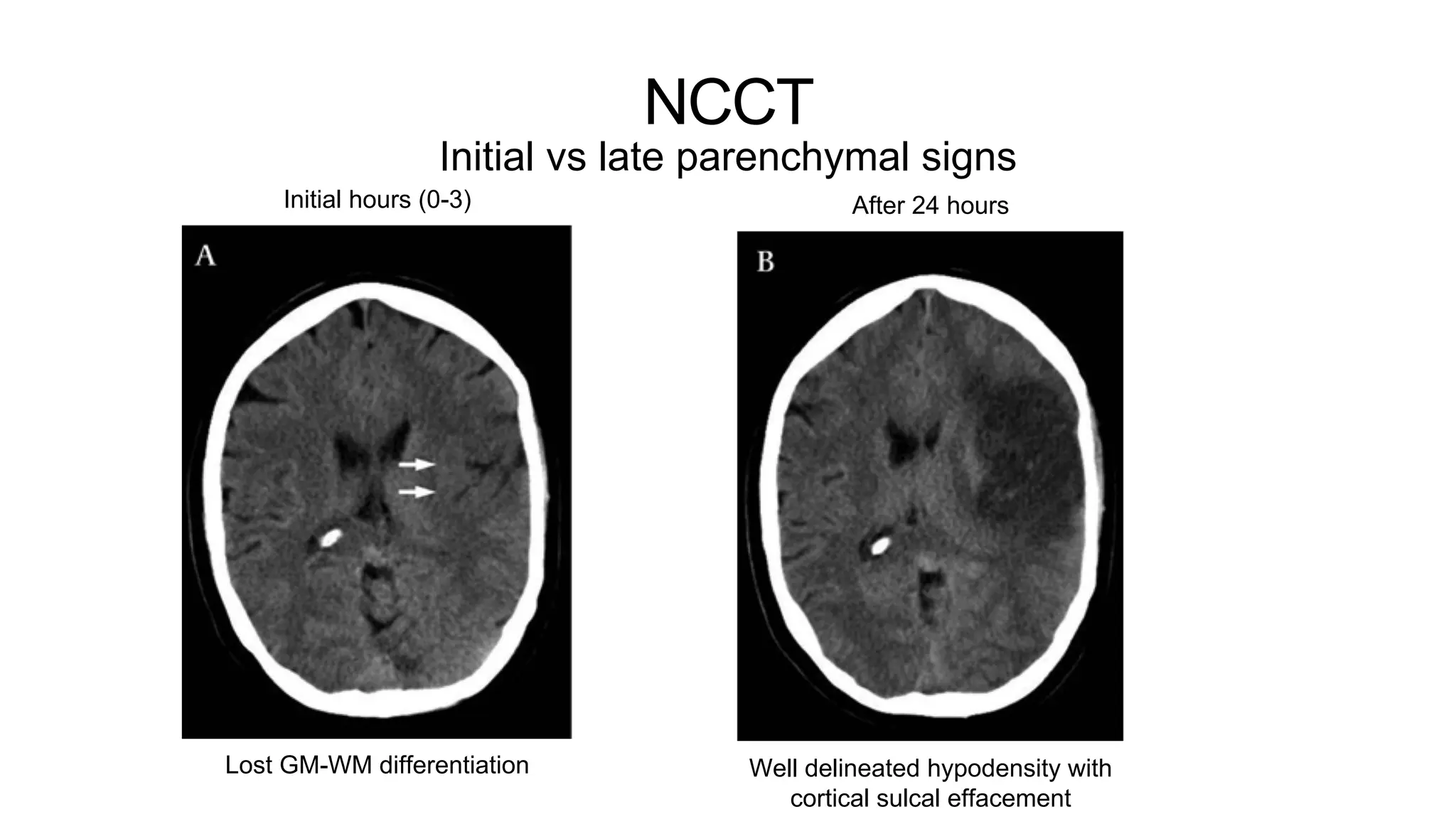 NCCT
Initial vs late parenchymal signs
Initial hours (0-3)
Lost GM-WM differentiation
After 24 hours
Well delineated hypodensity with
cortical sulcal effacement
 