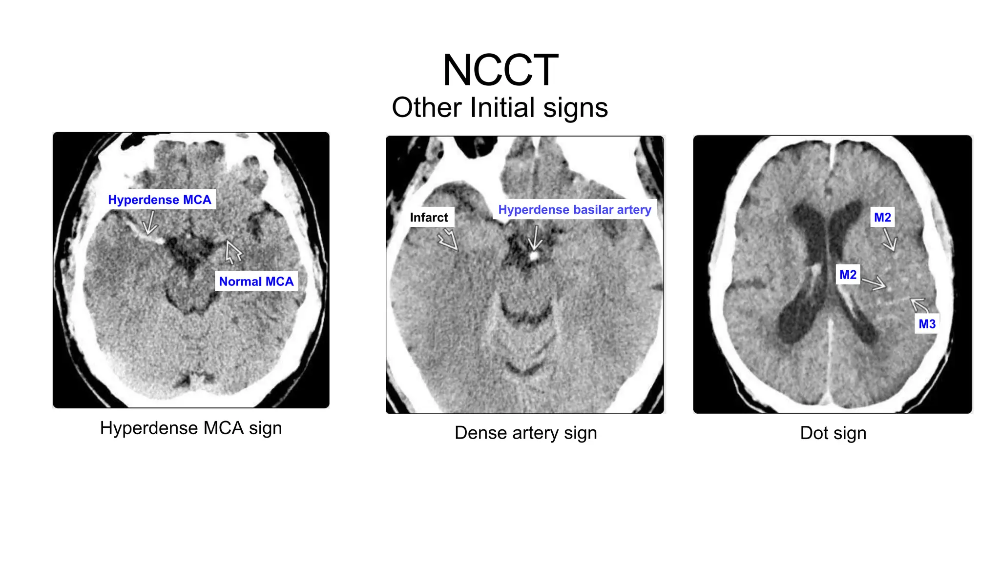 NCCT
Other Initial signs
Hyperdense MCA sign Dense artery sign
Hyperdense MCA
Normal MCA
Hyperdense basilar artery
Infarct
Dot sign
M2
M2
M3
 