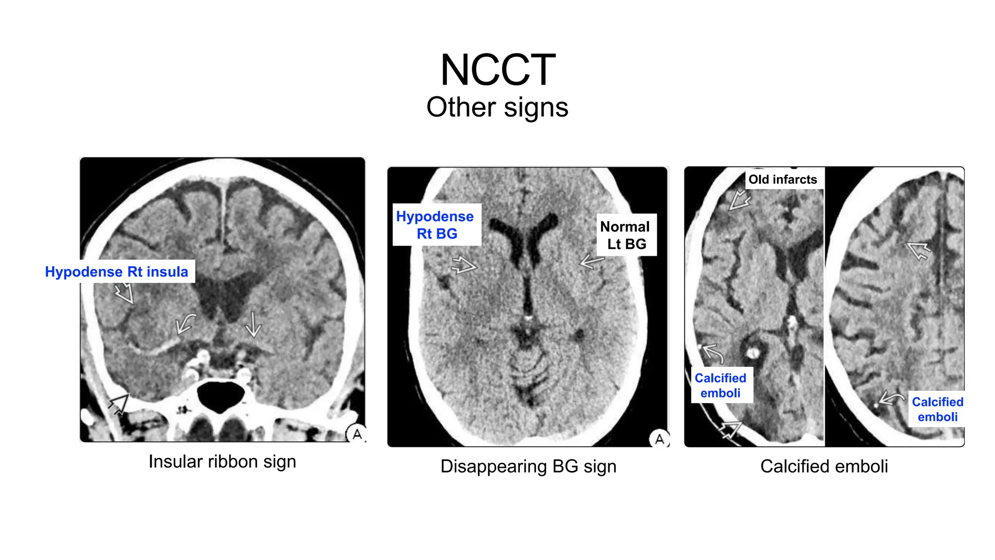 NCCT
Other signs
Insular ribbon sign
Hypodense Rt insula
Disappearing BG sign
Hypodense
Rt BG Normal
Lt BG
Calcified emboli
Old infarcts
Calcified
emboli
Calcified
emboli
 