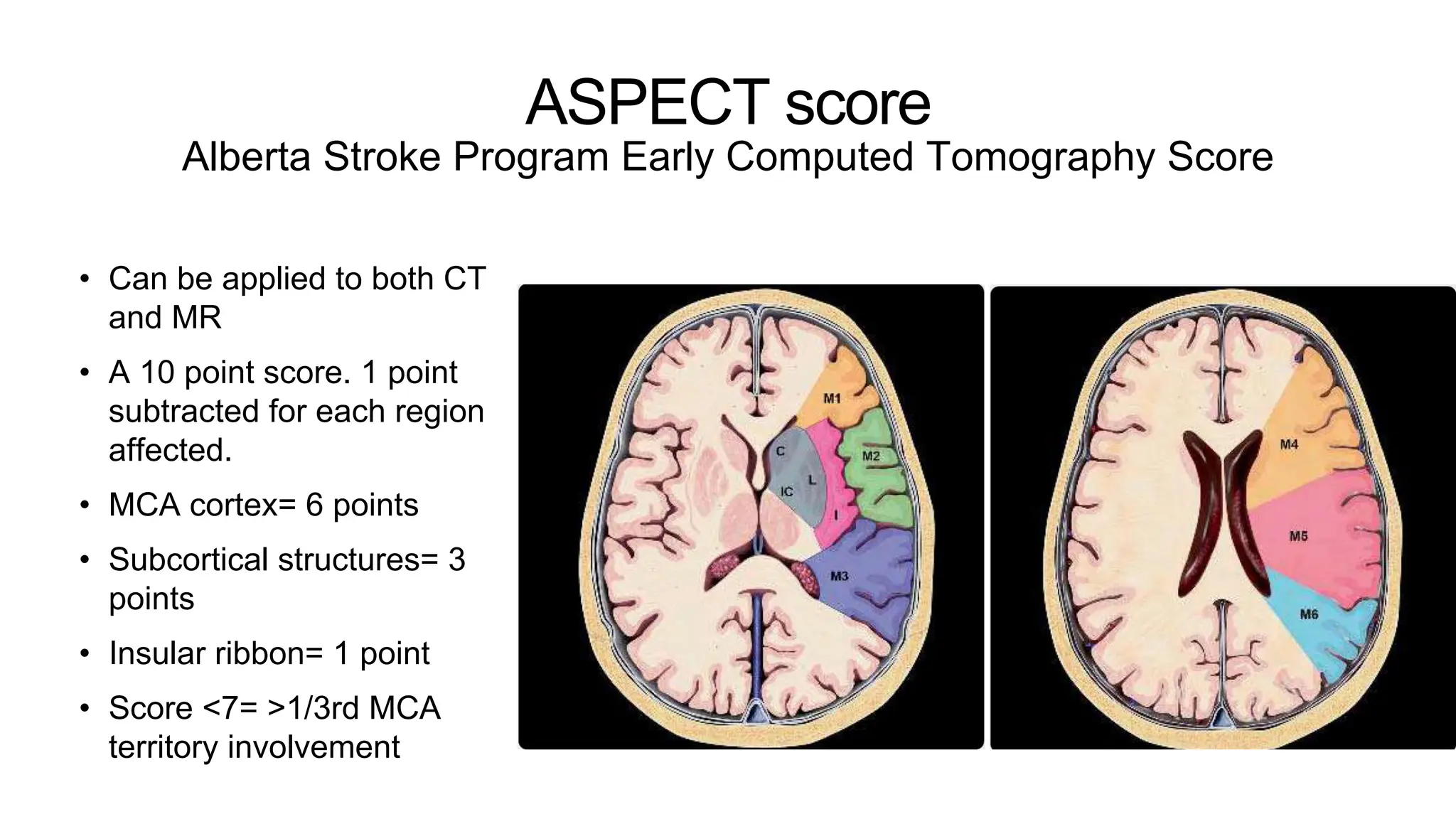 ASPECT score
Alberta Stroke Program Early Computed Tomography Score
• Can be applied to both CT
and MR
• A 10 point score. 1 point
subtracted for each region
affected.
• MCA cortex= 6 points
• Subcortical structures= 3
points
• Insular ribbon= 1 point
• Score <7= >1/3rd MCA
territory involvement
 