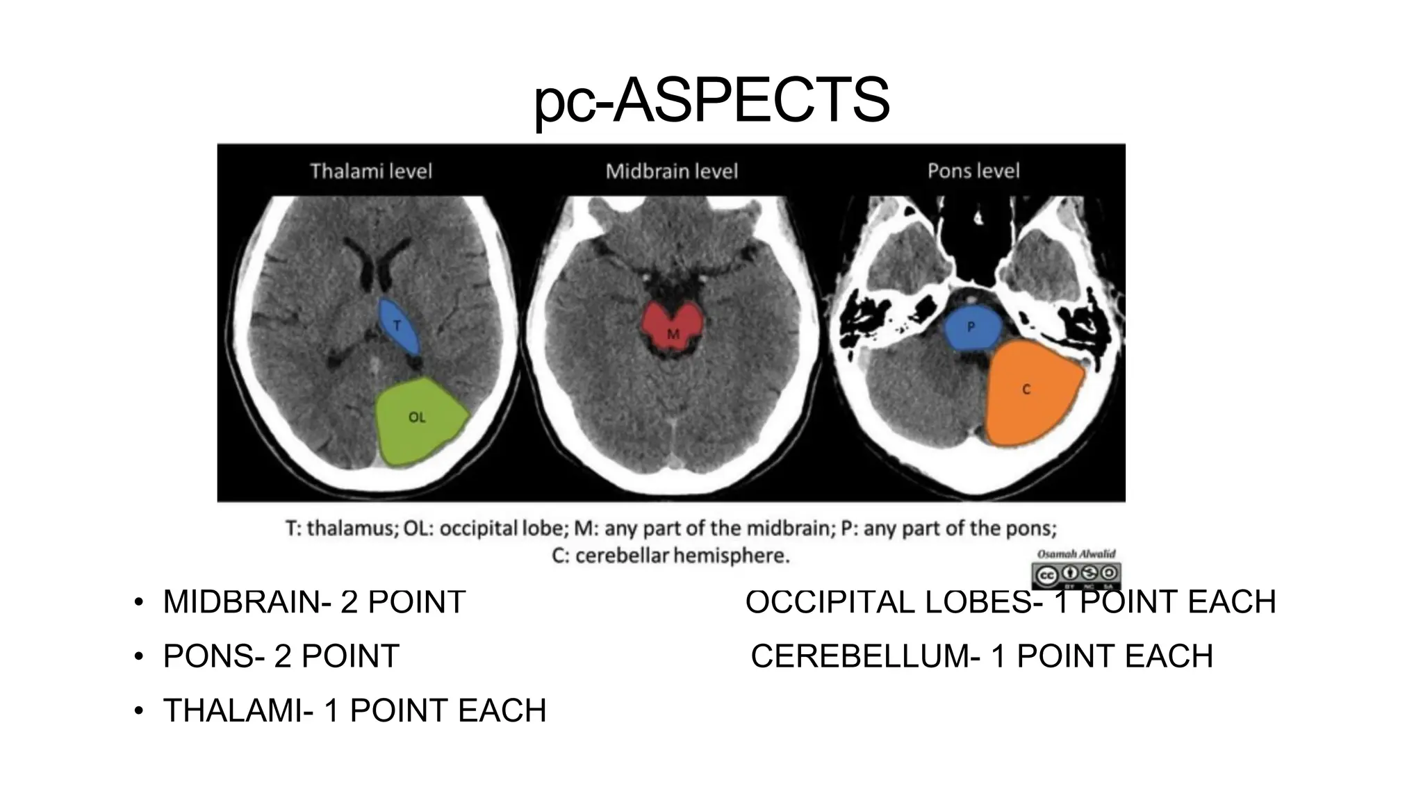 pc-ASPECTS
• MIDBRAIN- 2 POINT OCCIPITAL LOBES- 1 POINT EACH
• PONS- 2 POINT CEREBELLUM- 1 POINT EACH
• THALAMI- 1 POINT EACH
 