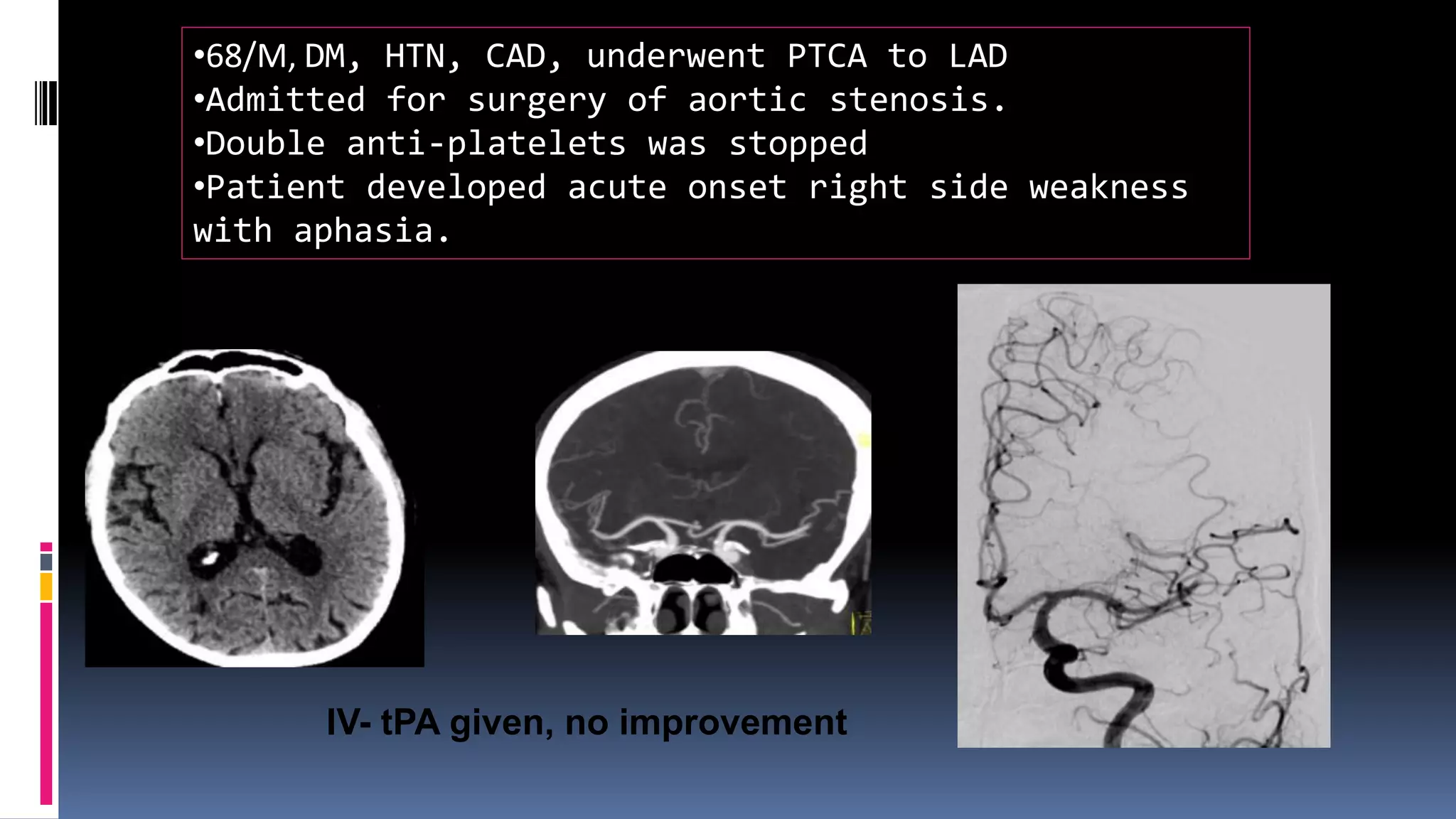 •68/M, DM, HTN, CAD, underwent PTCA to LAD
•Admitted for surgery of aortic stenosis.
•Double anti-platelets was stopped
•Patient developed acute onset right side weakness
with aphasia.
IV- tPA given, no improvement
 