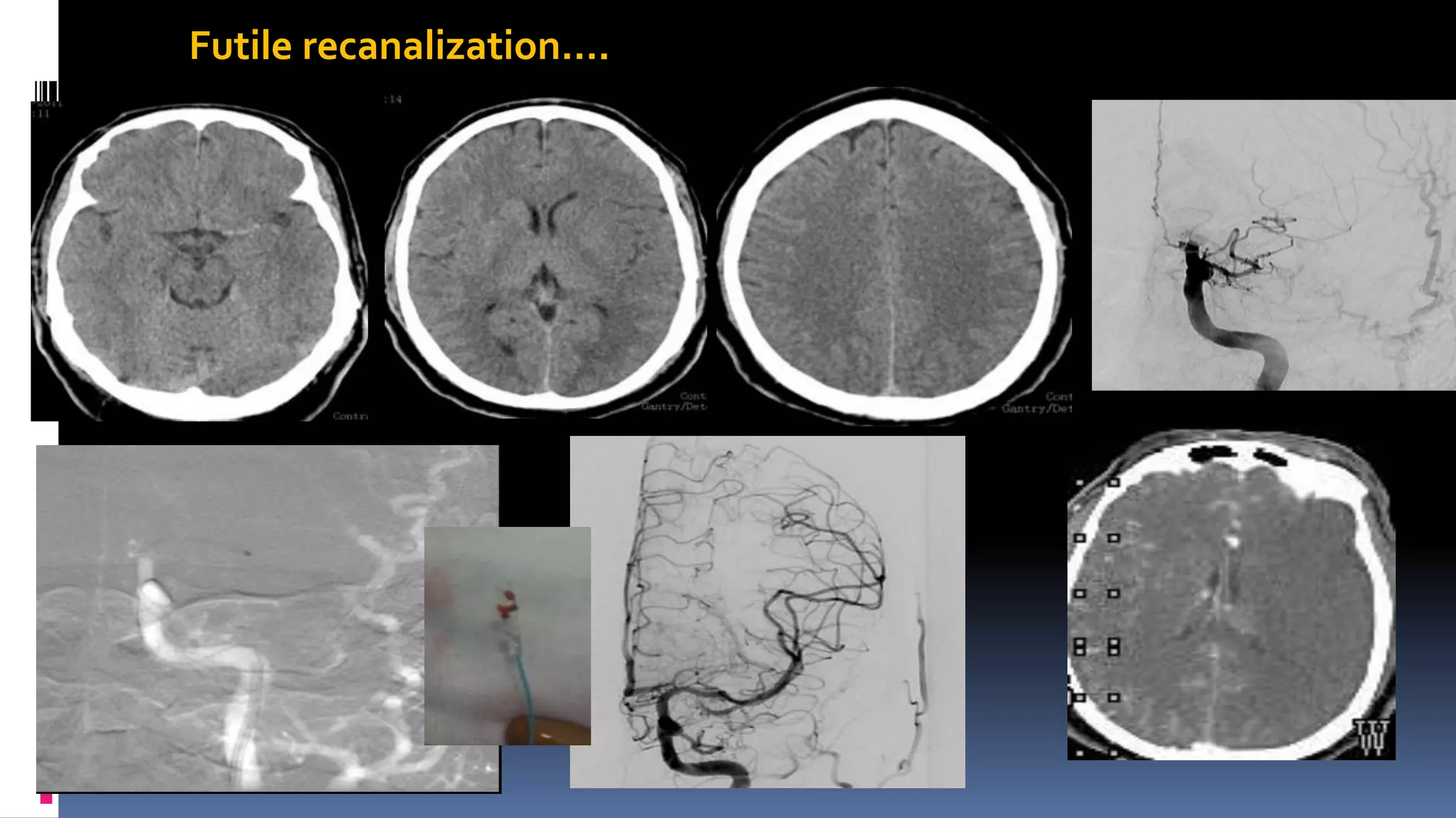 Futile recanalization….
 