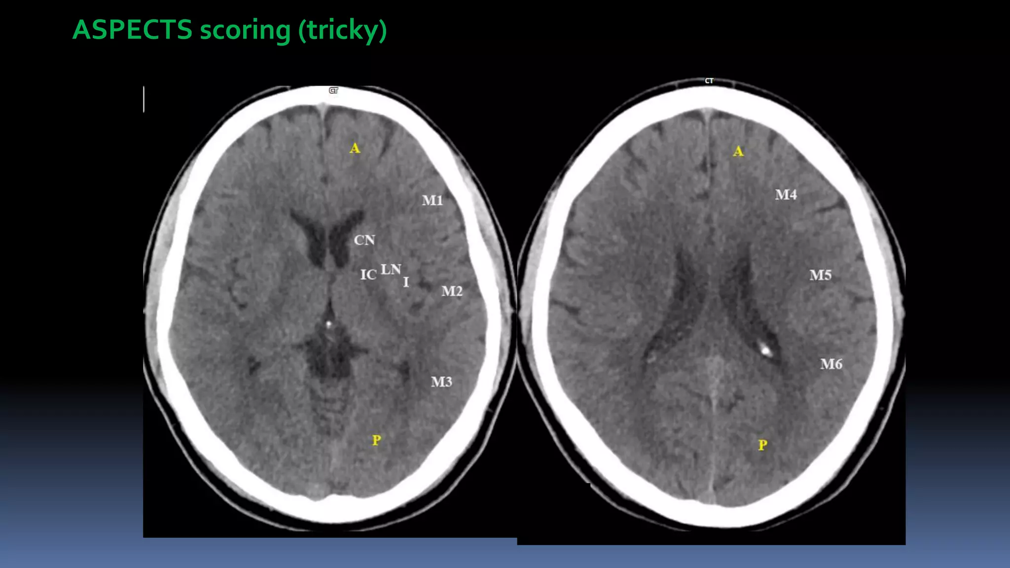 ASPECTS scoring (tricky)
 