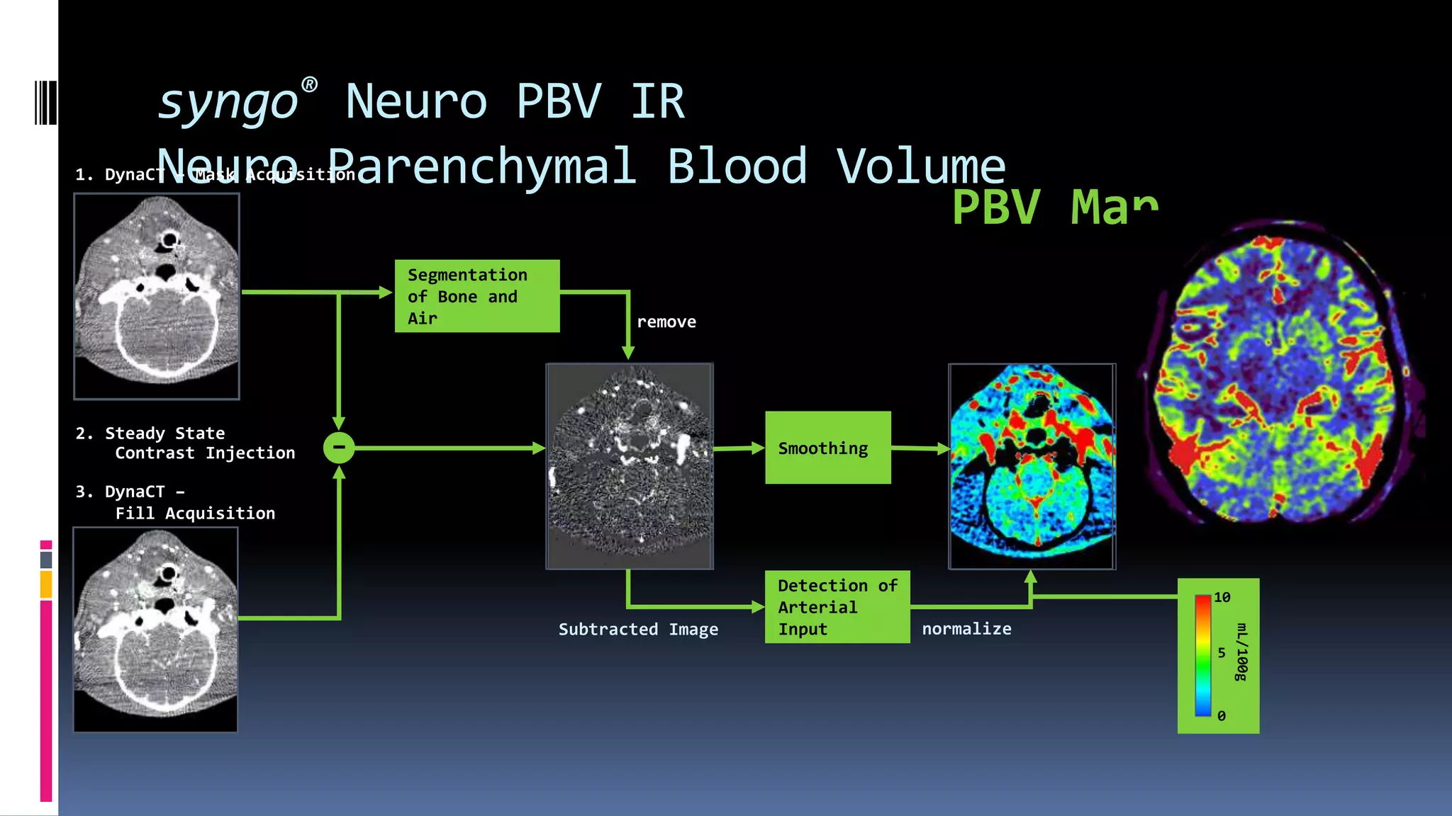 syngo® Neuro PBV IR
Neuro Parenchymal Blood Volume1. DynaCT – Mask Acquisition
2. Steady State
Contrast Injection
3. DynaCT –
Fill Acquisition
Segmentation
of Bone and
Air
–
Subtracted Image
remove
Detection of
Arterial
Input normalize
Smoothing
0
10
5
mL/100g
PBV Map
 