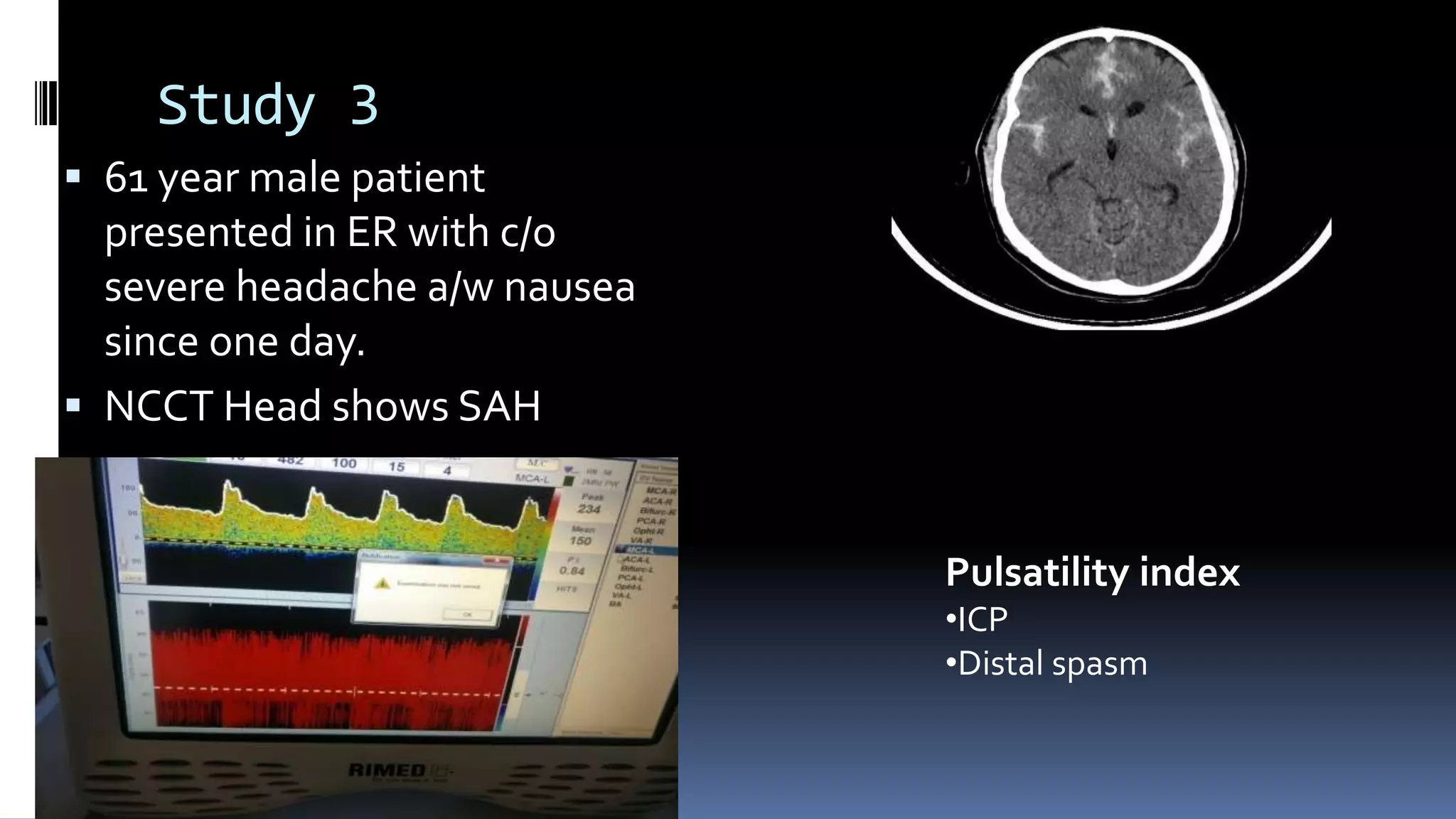 Study 3
 61 year male patient
presented in ER with c/o
severe headache a/w nausea
since one day.
 NCCT Head shows SAH
Pulsatility index
•ICP
•Distal spasm
 