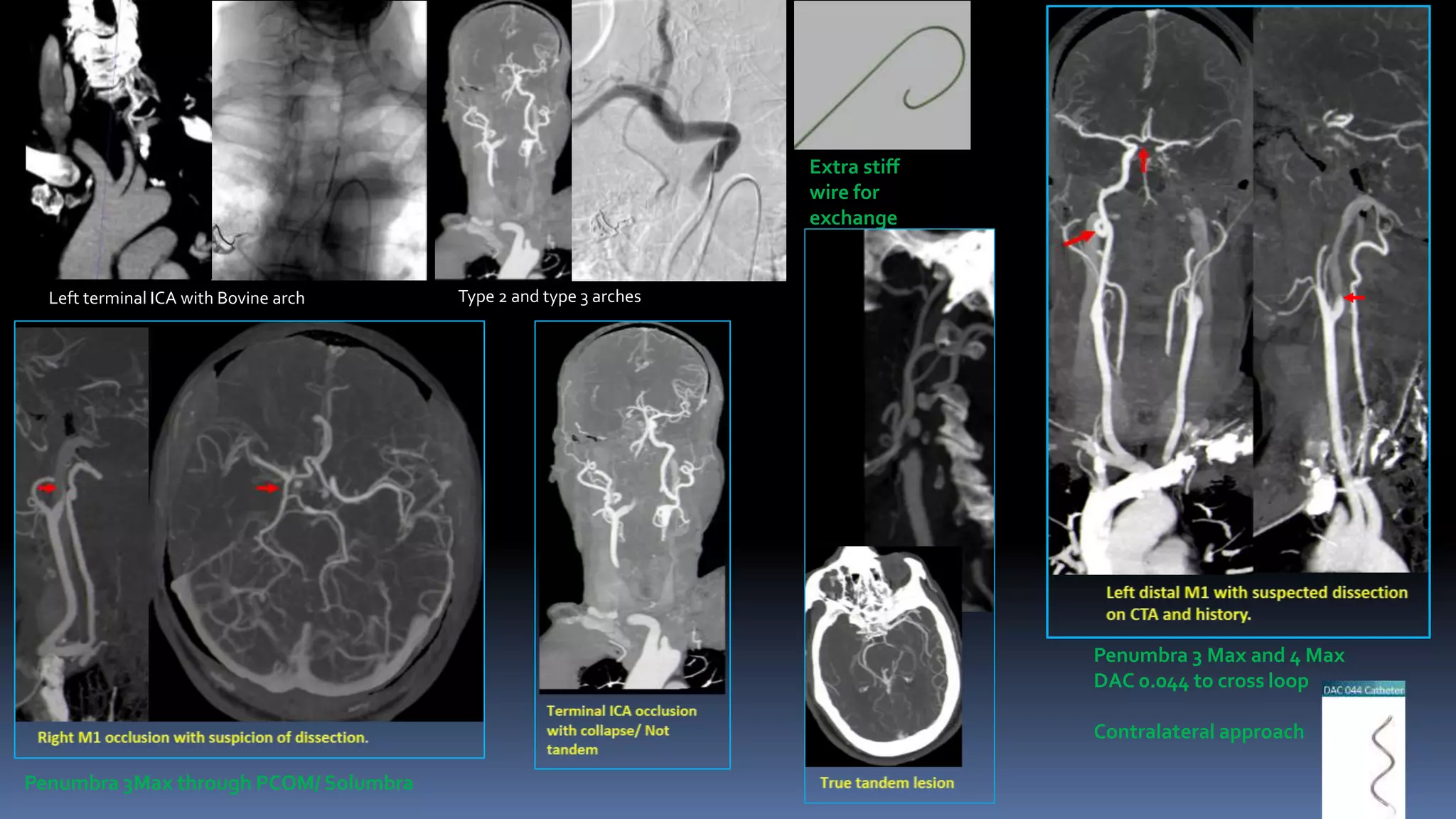 Left terminal ICA with Bovine arch Type 2 and type 3 arches
Extra stiff
wire for
exchange
Penumbra 3 Max and 4 Max
DAC 0.044 to cross loop
Contralateral approach
Penumbra 3Max through PCOM/ Solumbra
 
