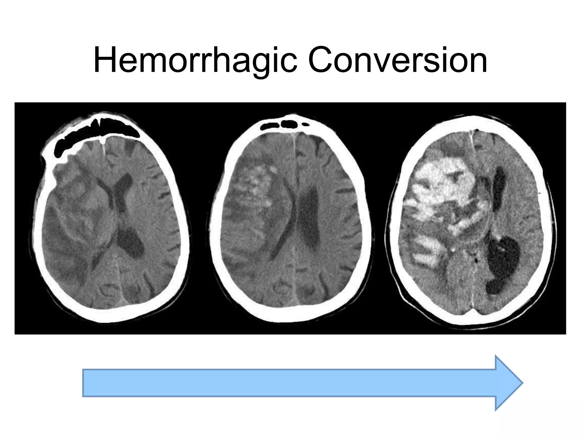 Hemorrhagic Conversion
 