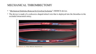 MECHANICAL THROMBECTOMY
• “Mechanical Embolus Removal In Cerebral Ischemia” (MERCI) device.
• The device is made of a corkscrew-shaped nitinol wire that is deployed into the thrombus in the
occluded intracranial artery.
 