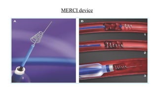 MERCI device
 