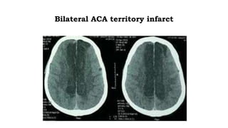 Ischemic Stroke investigations | PPTX