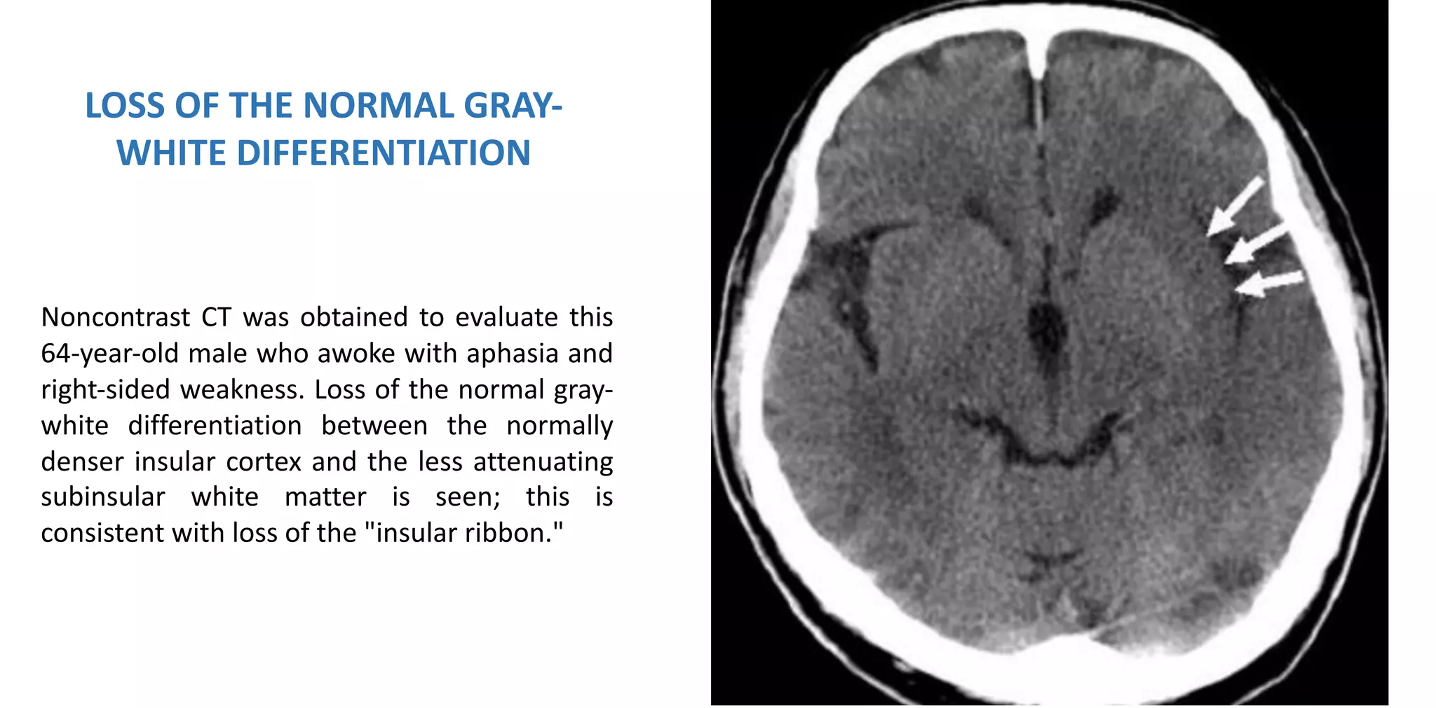 STROKE ENFERMEDAD CEREBROVASCULAR | PDF