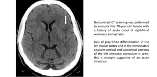 Opercular Acute Infarct STROKE ENFERMEDAD CEREBROVASCULAR | PDF