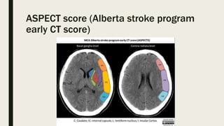Acute ischemic stroke | PPTX