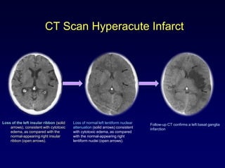 CT Scan Hyperacute Infarct




Loss of the left insular ribbon (solid   Loss of normal left lentiform nuclear   Follow-up CT confirms a left basal ganglia
    arrows), consistent with cytotoxic   attenuation (solid arrows) consistent   infarction
    edema, as compared with the          with cytotoxic edema, as compared
    normal-appearing right insular       with the normal-appearing right
    ribbon (open arrows).                lentiform nuclei (open arrows).
 