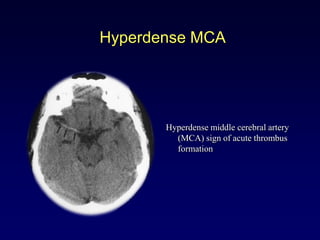 Hyperdense MCA




       Hyperdense middle cerebral artery
         (MCA) sign of acute thrombus
         formation
 
