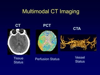 Multimodal CT Imaging

 CT            PCT
                             CTA




Tissue    Perfusion Status   Vessel
Status                       Status
 
