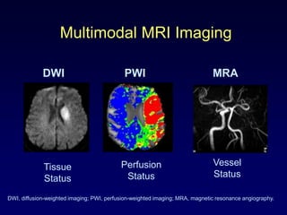 Multimodal MRI Imaging

             DWI                            PWI                               MRA




             Tissue                        Perfusion                          Vessel
             Status                         Status                            Status

DWI, diffusion-weighted imaging; PWI, perfusion-weighted imaging; MRA, magnetic resonance angiography.
 