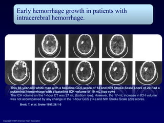 Early hemorrhage growth in patients with
               intracerebral hemorrhage.




 •      This 66-year-old white man with a baseline GCS score of 14 and NIH Stroke Scale score of 20 had a
        putaminal hemorrhage with a baseline ICH volume of 10 mL (top row)
 •      The ICH volume on the 1-hour CT was 27 mL (bottom row). However, the 17-mL increase in ICH volume
        was not accompanied by any change in the 1-hour GCS (14) and NIH Stroke Scale (20) scores.
                   Brott, T. et al. Sroke 1997;28:1-5




Copyright ©1997 American Heart Association
 