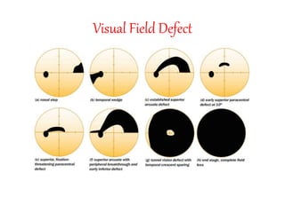 Visual Field Defect
 