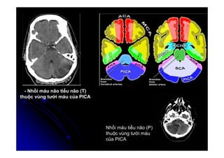 10
10
- Nhồi máu não tiểu não (T)
thuộc vùng tưới máu của PICA
Nhồi máu tiểu não (P)
thuộc vùng tưới máu
của PICA
 