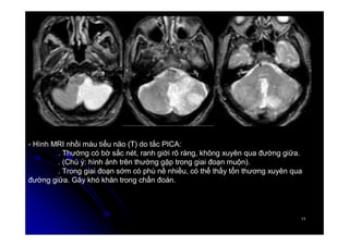 11
11
- Hình MRI nhồi máu tiểu não (T) do tắc PICA:
. Thường có bờ sắc nét, ranh giới rõ ràng, không xuyên qua đường giữa.
. (Chú ý: hình ảnh trên thường gặp trong giai đoạn muộn).
. Trong giai đoạn sớm có phù nề nhiều, có thể thấy tổn thương xuyên qua
đường giữa. Gây khó khăn trong chẩn đoán.
 
