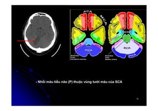 12
12
- Nhồi máu tiểu não (P) thuộc vùng tưới máu của SCA
 