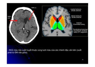 15
15
- Nhồi máu não xuất huyết thuộc vùng tưới máu của các nhánh đậu vân bên (xuất
phát từ ĐM não giữa).
NMN cũ
NMN
mới
 