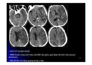 16
16
- Hình CT có tiêm thuốc.
- NMN thuộc vùng tưới máu của ĐM não giữa, giai đoạn tái tưới máu (luxury
perfusion).
- Rất dễ lầm với tăng quang trong u não.
 