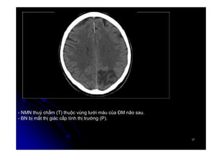 17
17
- NMN thuỳ chẩm (T) thuộc vùng tưới máu của ĐM não sau.
- BN bị mất thị giác cấp tính thị trường (P).
 