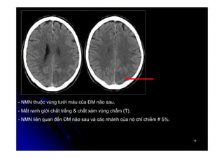 18
18
- NMN thuộc vùng tưới máu của ĐM não sau.
- Mất ranh giới chất trắng & chất xám vùng chẩm (T).
- NMN liên quan đến ĐM não sau và các nhánh của nó chỉ chiếm # 5%.
 