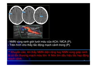 21
21
- NMN vùng ranh giới tưới máu của ACA / MCA (P).
- Trên hình cho thấy tắc động mạch cảnh trong (P).
** Khuyến cáo: khi thấy NMN diện rộng hay NMN vùng giáp ranh
là có tổn thương mạch máu lớn  Nên tìm dấu hiệu tắc hẹp động
mạch cảnh.
 