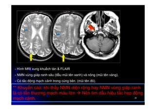 22
22
- Hình MRI xung khuếch tán & FLAIR
- NMN vùng giáp ranh sâu (đầu mũi tên xanh) và nông (mũi tên vàng).
- Có tắc động mạch cảnh trong cùng bên. (mũi tên đỏ).
** Khuyến cáo: khi thấy NMN diện rộng hay NMN vùng giáp ranh
là có tổn thương mạch máu lớn  Nên tìm dấu hiệu tắc hẹp động
mạch cảnh.
 