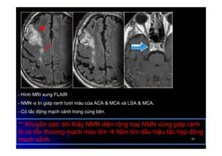 23
23
- Hình MRI xung FLAIR
- NMN vị trí giáp ranh tưới máu của ACA & MCA và LSA & MCA.
- Có tắc động mạch cảnh trong cùng bên.
** Khuyến cáo: khi thấy NMN diện rộng hay NMN vùng giáp ranh
là có tổn thương mạch máu lớn  Nên tìm dấu hiệu tắc hẹp động
mạch cảnh.
 