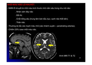25
25
NHỒI MÁU NÃO LỖ KHUYẾT:
- NMN lỗ khuyết là nhồi máu kích thước nhỏ nằm sâu trong nhu mô não:
. Nhân xám đáy não
. Đồi thị
. Chất trắng sâu (trung tâm bán bầu dục; cạnh não thất bên).
. Thân não.
- Thường do tắc các mạch máu nhỏ (các nhánh xuyên – penetrating arteries).
- Chiếm 25% case nhồi máu não.
Hình MRI T1 & T2
 