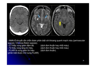 26
26
- NMN lỗ khuyết cần chẩn đoán phân biệt với khoang quanh mạch máu (perivascular
spaces / Virchow-Robin spaces).
- CT thấy vùng giảm đậm độ. (dịch đơn thuần hay nhồi máu).
- T2 thấy vùng tăng tín hiệu. (dịch đơn thuần hay nhồi máu)
- FLAIR là vùng giảm tín hiệu (dịch đơn thuần).
(phân biệt được nhờ xung FLAIR)
 