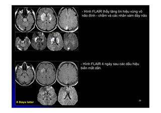 29
29
- Hình FLAIR thấy tăng tín hiệu vùng vỏ
não đính - chẩm và các nhân xám đáy não
- Hình FLAIR 4 ngày sau các dấu hiệu
biến mất dần.
 