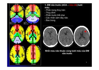 3
3
1. ĐM não trước (ACA – màu đỏ) tưới
máu:
- Phần trong thùy trán
- Thùy đính
- Phần trước thể chai
- Các nhân xám đáy não
- Bao trong.
Nhồi máu não thuộc vùng tưới máu của ĐM
não trước
 