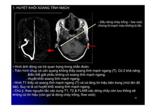 33
33
• Hình ảnh đóng vai trò quan trọng trong chẩn đoán:
- Trên hình chụp có cản quang không thấy xoang tĩnh mạch ngang (T). Có 2 khả năng:
. Biến thể giải phẩu không có xoang tĩnh mạch ngang.
. Huyết khối xoang tĩnh mạch ngang.
- Hình T1 thấy có xoang tĩnh mạch ngang (T) và có tăng tín hiệu bên trong (mũi tên đỏ
dài). Suy ra là có huyết khối xoang tĩnh mạch ngang.
- Chú ý: theo nguyên tắc các xung T1, T2 & FLAIR các dòng chảy còn lưu thông sẽ
không có tín hiệu (còn gọi là dòng chảy trống, flow void).
- Dấu dòng chảy trống – fow void,
chứng tỏ mạch máu không bị tắc.
1. HUYẾT KHỐI XOANG TĨNH MẠCH:
 