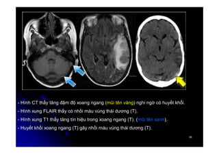 34
34
- Hình CT thấy tăng đậm độ xoang ngang (mũi tên vàng) nghi ngờ có huyết khối.
- Hình xung FLAIR thấy có nhồi máu vùng thái dương (T).
- Hình xung T1 thấy tăng tín hiệu trong xoang ngang (T). (mũi tên xanh),
- Huyết khối xoang ngang (T) gây nhồi máu vùng thái dương (T).
 