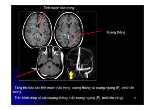 36
36
- Tăng tín hiệu các tĩnh mạch não trong, xoang thẳng và xoang ngang (P). (mũi tên
xanh).
- Trên hình chụp có cản quang không thấy xoang ngang (P). (mũi tên vàng).
Xoang thẳng
Tĩnh mạch não trong.
 