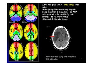 4
4
2. ĐM não giữa (MCA – màu vàng) tưới
máu:
- Bề mặt ngoài của vỏ não (trừ phần
trong thùy trán & thùy đính – do ACA
tưới máu) và phần dưới thùy thái
dương – do PCA tưới máu).
- Các nhánh đậu vân trong.
Nhồi máu não vùng tưới máu của
ĐM não giữa.
 