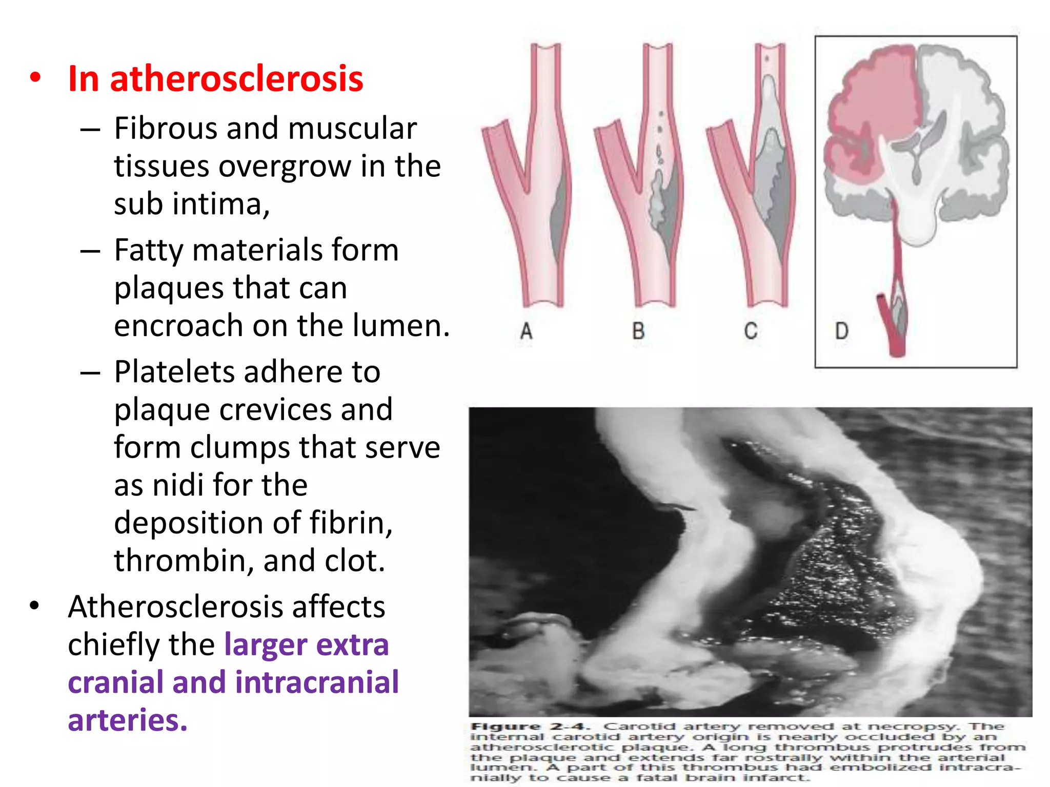 • In atherosclerosis
– Fibrous and muscular
tissues overgrow in the
sub intima,
– Fatty materials form
plaques that can
encroach on the lumen.
– Platelets adhere to
plaque crevices and
form clumps that serve
as nidi for the
deposition of fibrin,
thrombin, and clot.
• Atherosclerosis affects
chiefly the larger extra
cranial and intracranial
arteries.
 