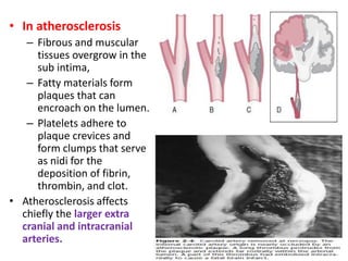 • In atherosclerosis
– Fibrous and muscular
tissues overgrow in the
sub intima,
– Fatty materials form
plaques that can
encroach on the lumen.
– Platelets adhere to
plaque crevices and
form clumps that serve
as nidi for the
deposition of fibrin,
thrombin, and clot.
• Atherosclerosis affects
chiefly the larger extra
cranial and intracranial
arteries.
 
