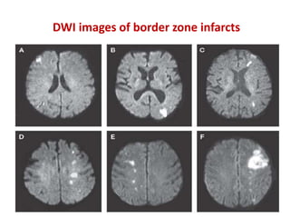 DWI images of border zone infarcts
 
