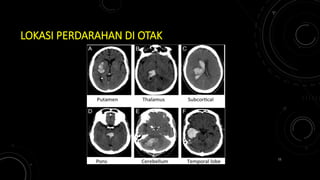 LOKASI PERDARAHAN DI OTAK
11
 