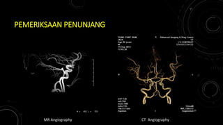 PEMERIKSAAN PENUNJANG
MR Angiography CT Angiography
25
 