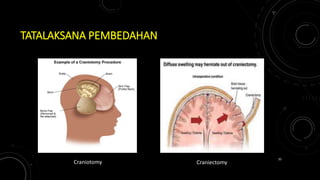 TATALAKSANA PEMBEDAHAN
Craniotomy Craniectomy
35
 
